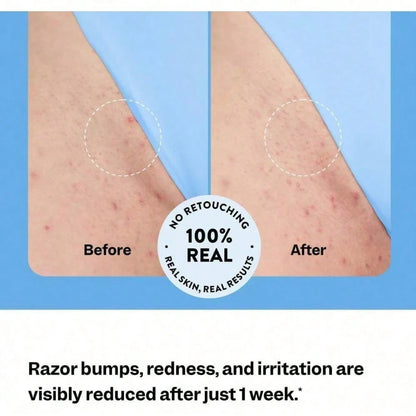 Smooth Repair Hair Regrowth Serum, Soothing Roll-On Serum After Hair Removal, Suitable For Men And Women, Soothes Sensitive Skin On Face, Underarms, And Bikini Area| Contains Salicylic Acid And Glyco