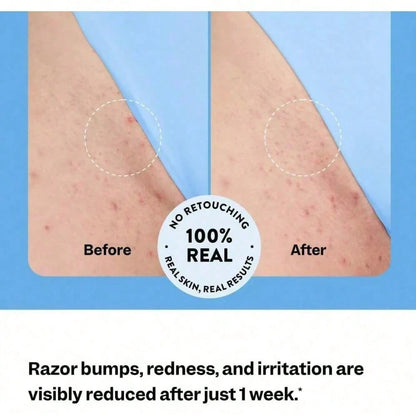 Smooth Repair Ingrown Hair Serum, Razor Bump Treatment, Suitable For Women And Men, Soothes And Calms Sensitive Skin On The Face, Underarms, And Bikini Area| Contains Salicylic Acid And Glycolic Acid