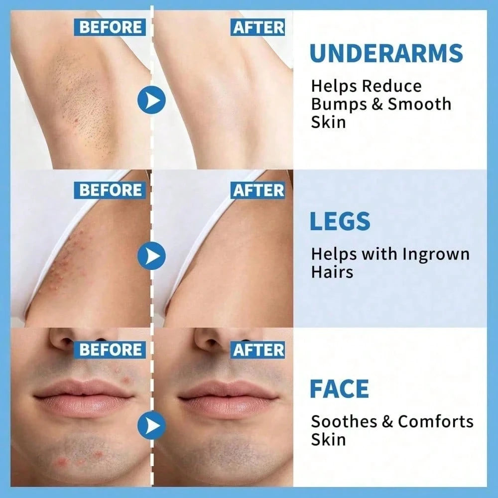 Smooth Repair Ingrown Hair Serum, Razor Bump Treatment, Suitable For Women And Men, Soothes And Calms Sensitive Skin On The Face, Underarms, And Bikini Area| Contains Salicylic Acid And Glycolic Acid